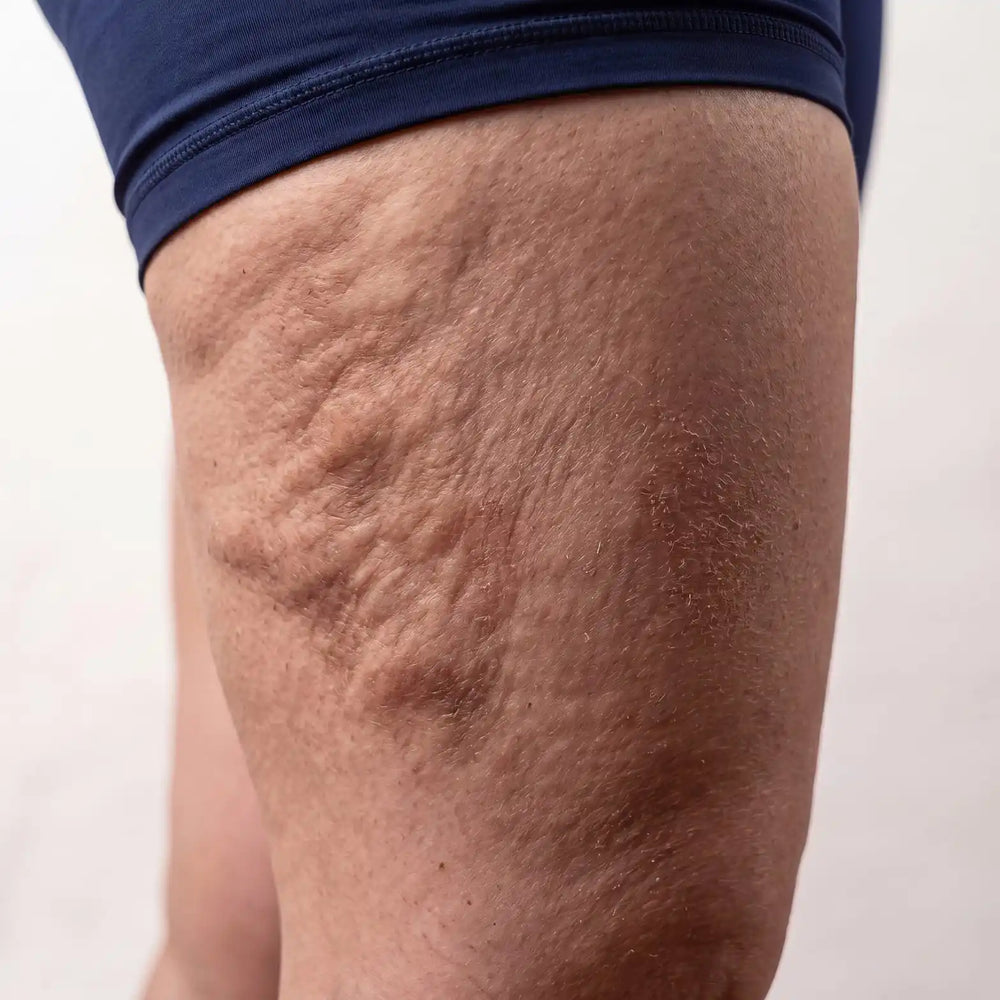 Florisu SOOTHE before_cellulite